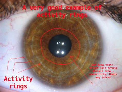 iridology_activityrings.jpg iridology_activityrings.jpg