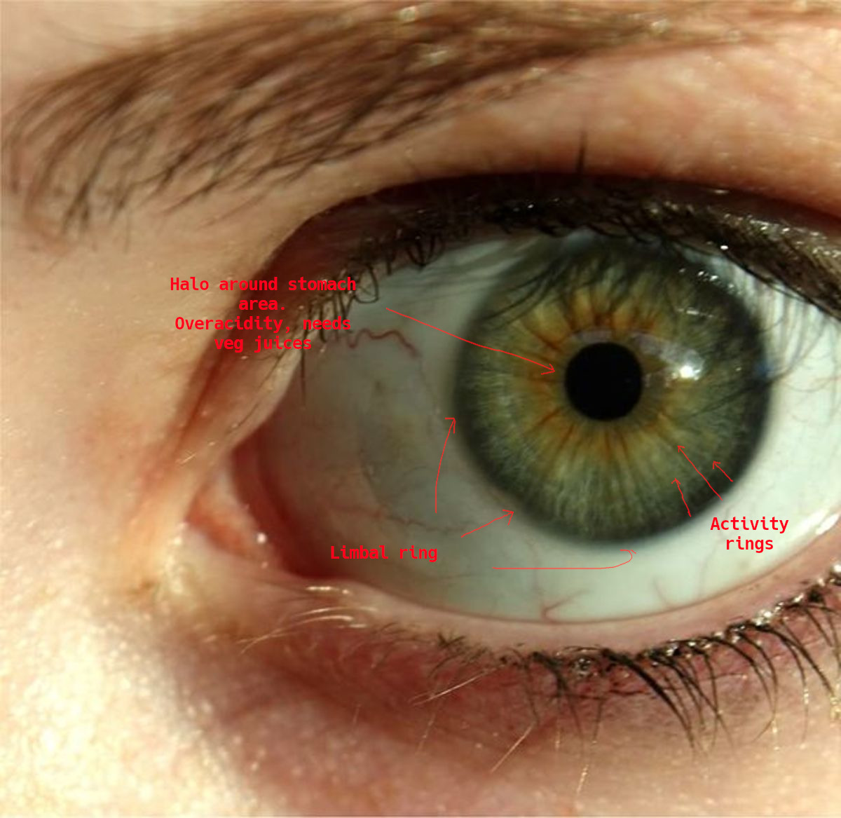 iridology_limbalring.jpg iridology_limbalring.jpg