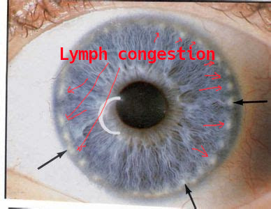 iridology_lymphaticcongestion.jpg iridology_lymphaticcongestion.jpg
