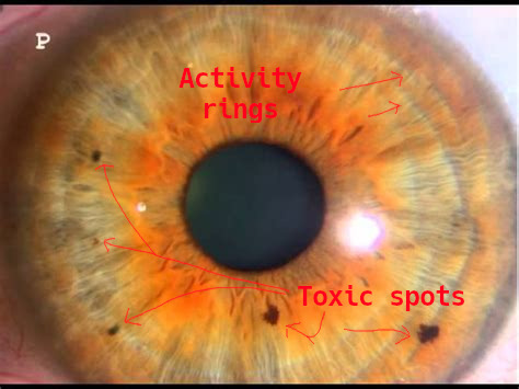 iridology_toxicspots1.jpg iridology_toxicspots1.jpg