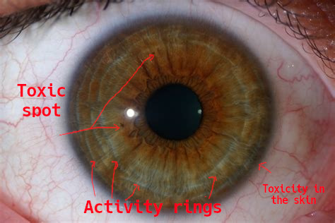 iridology_toxicspots2.jpg iridology_toxicspots2.jpg